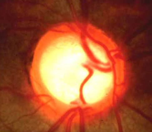 GLAUCOMA AND NEUROOPHTHALMOLOGY BLOG