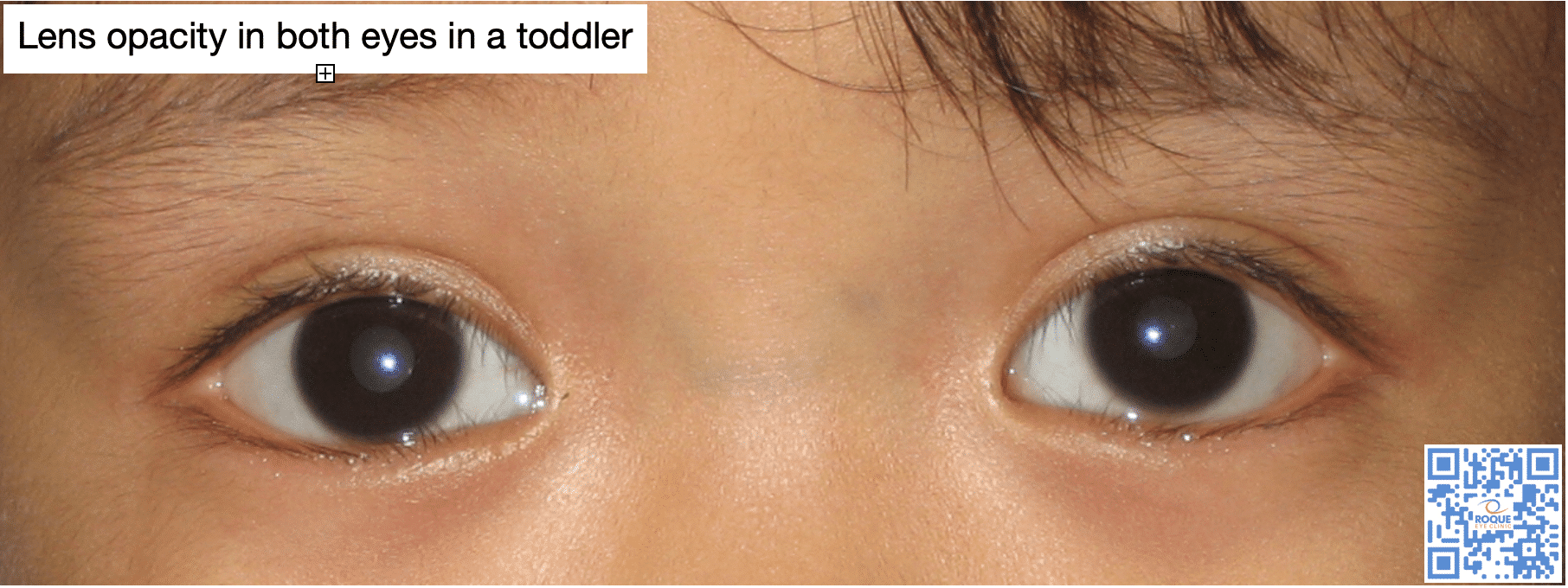 Bilateral lens opacity in a toddler