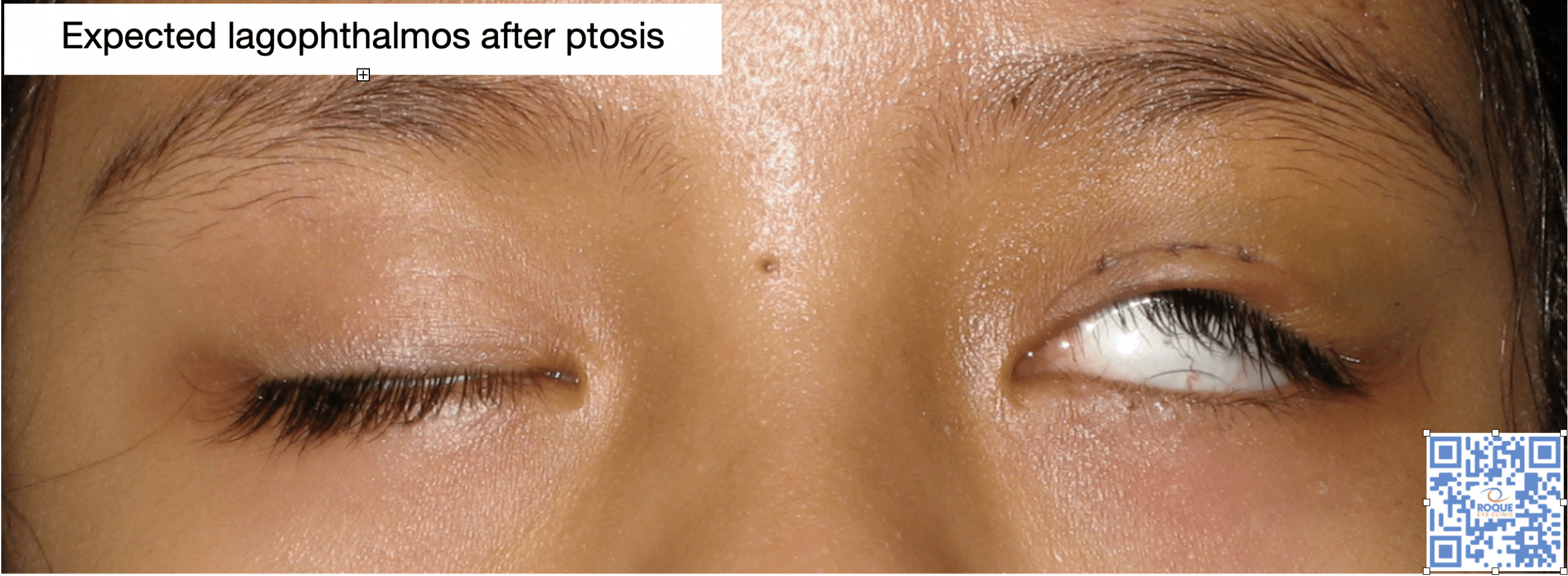 Expected lagophthalmos post ptosis surgery