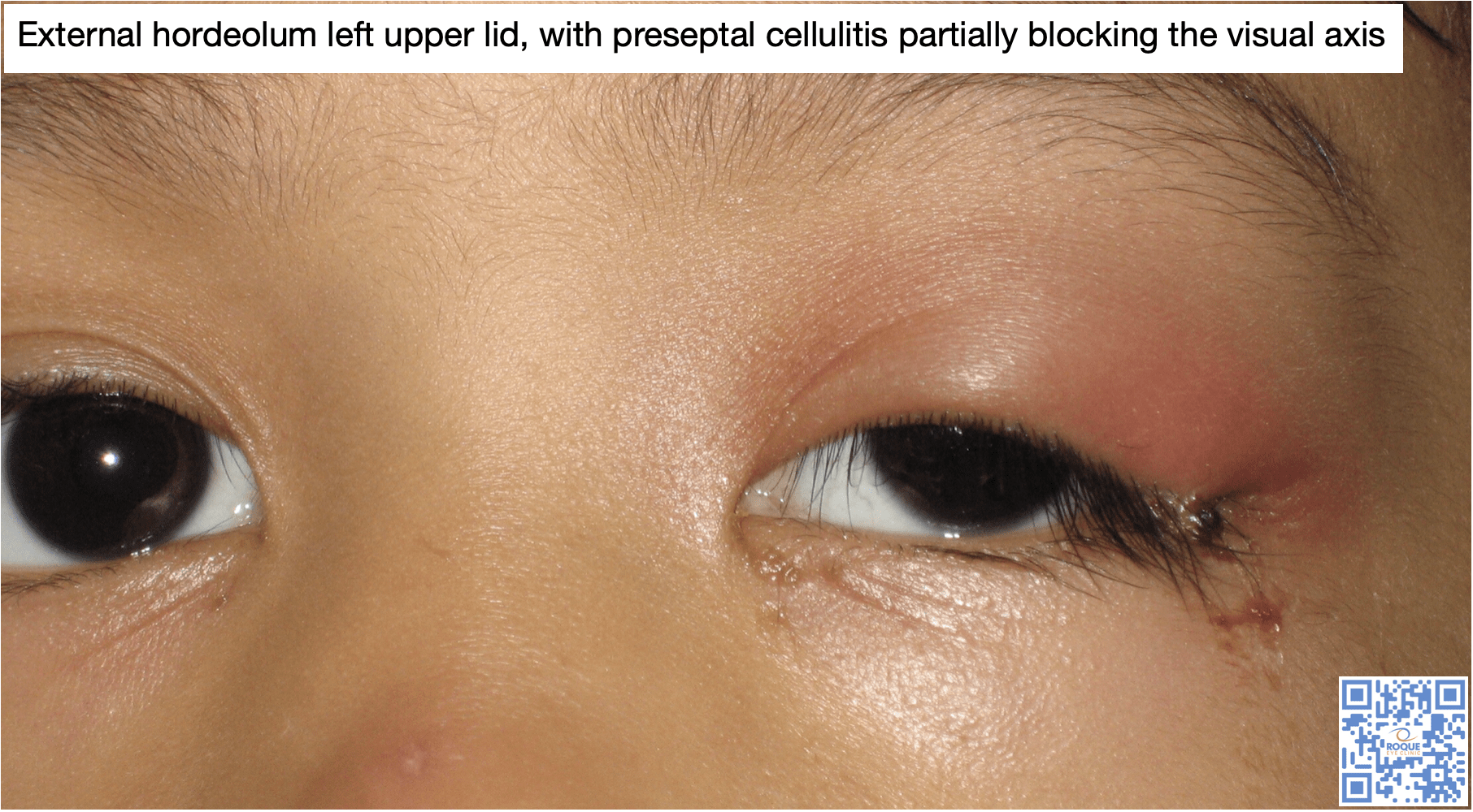 External hordeolum left upper lid, with preseptal cellulitis partially blocking the visual axis