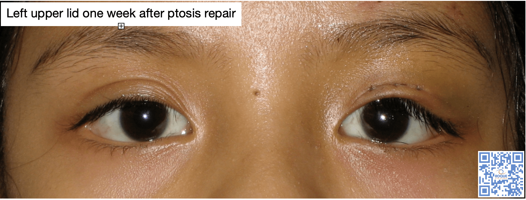 Left upper eyelid - 1 week post ptosis repair