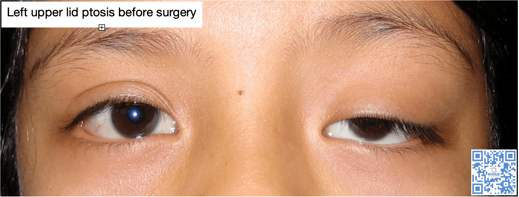 Left upper eyelid ptosis - pre-surgery