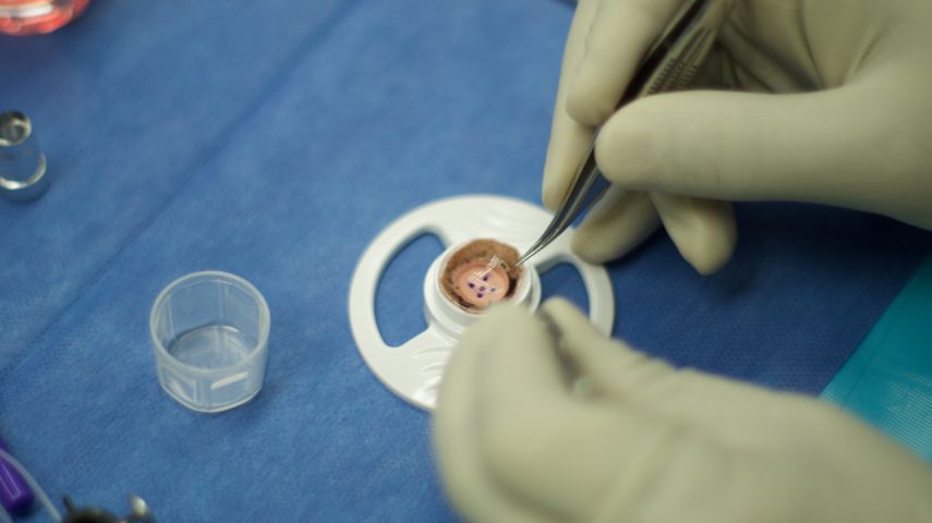 Preparing the donor corneal button.