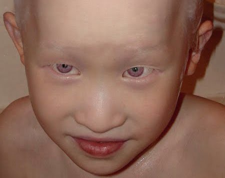 albinism vizual