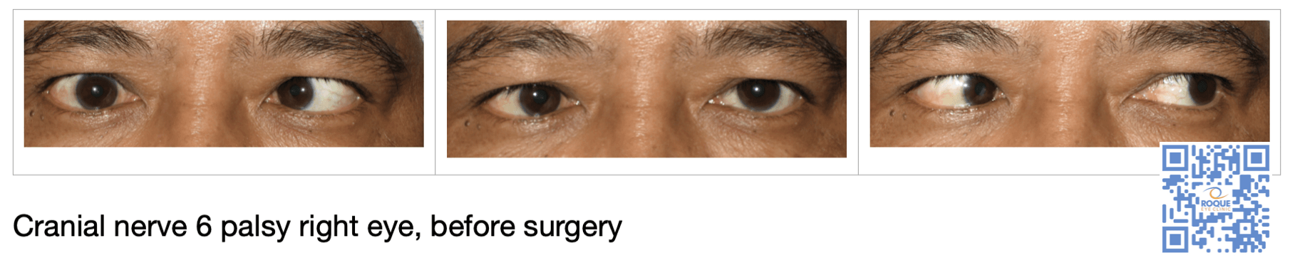 Cranial nerve 6 palsy right eye, before surgery