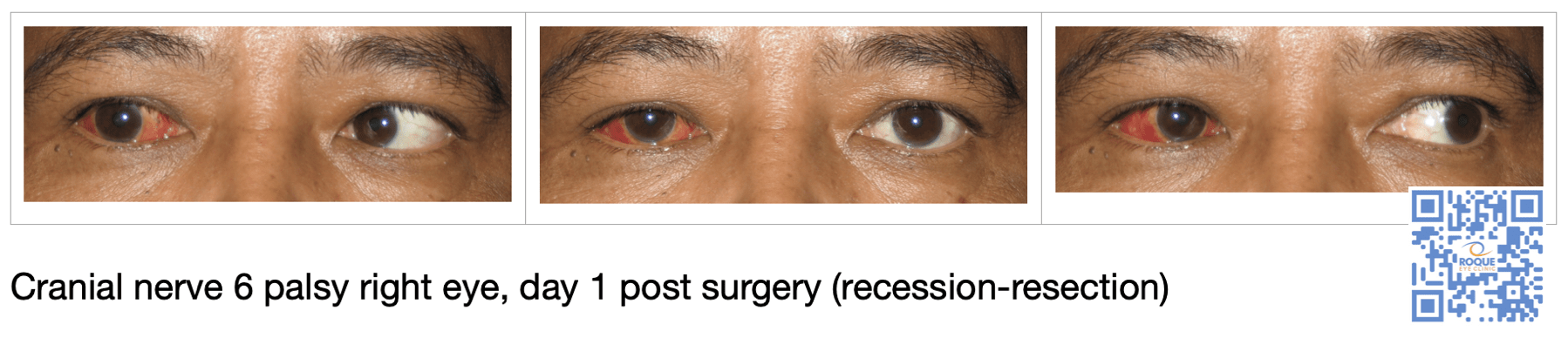 Cranial nerve 6 palsy right eye, day 1 post surgery (recession-resection)