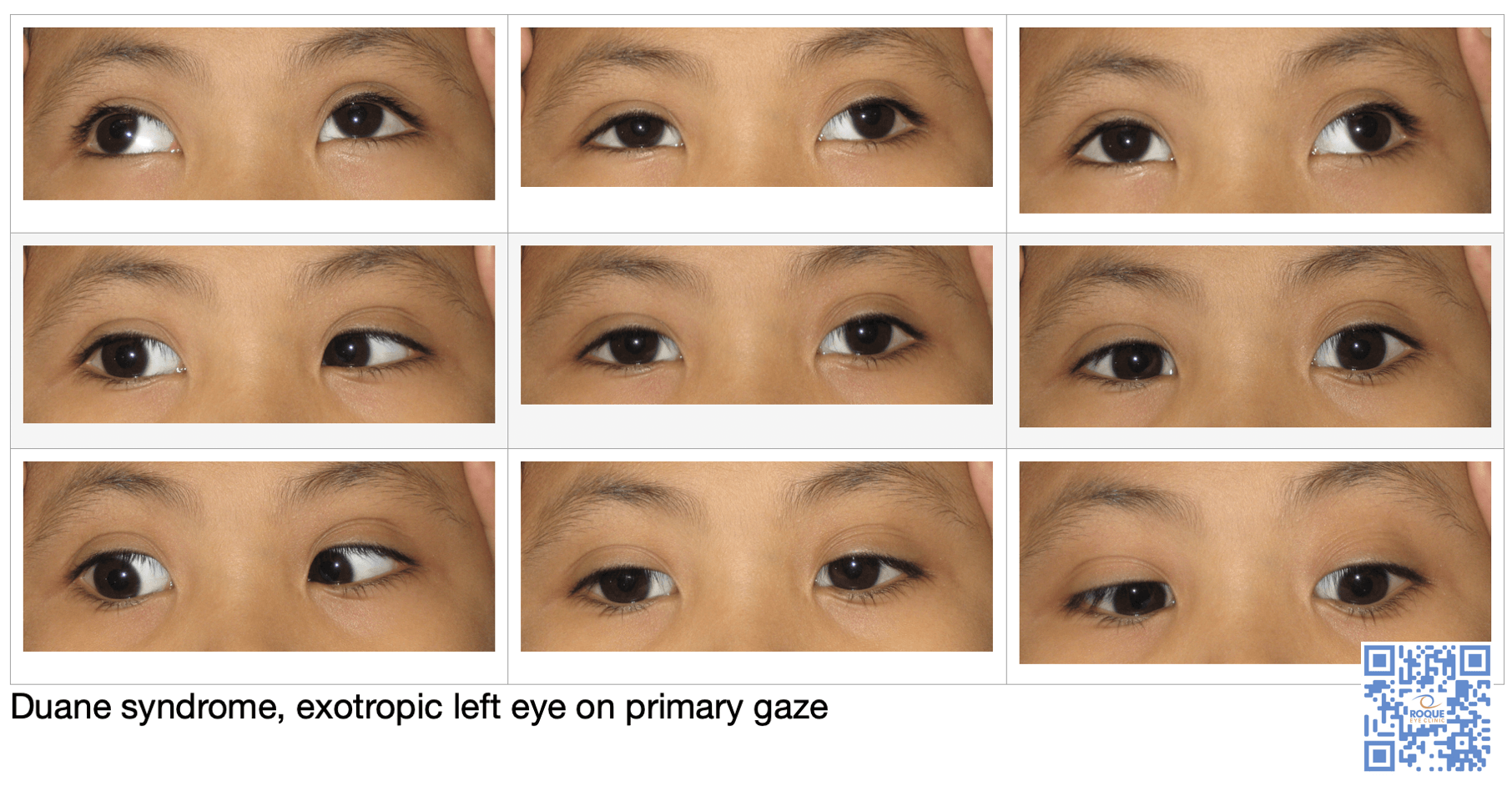 Duane syndrome, exotropic left eye on primary gaze