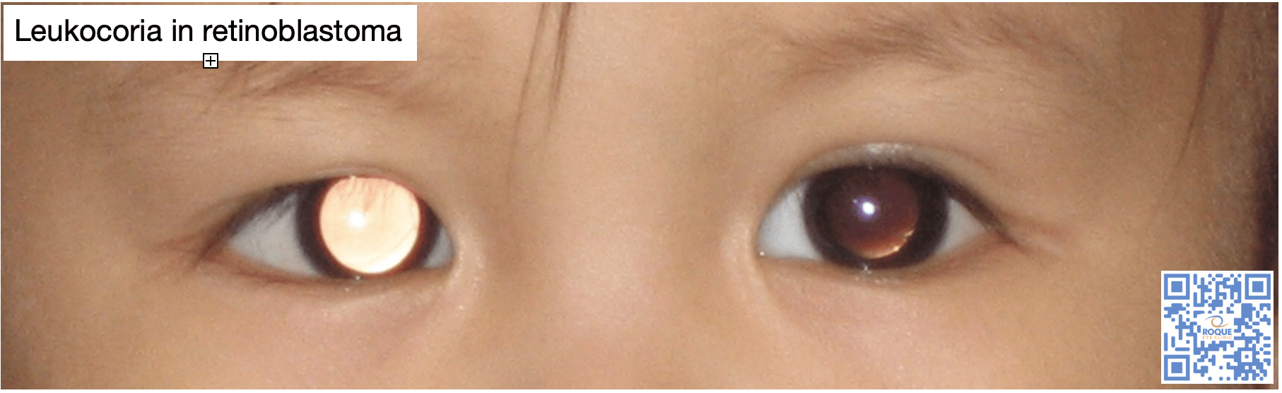 Leukocoria in retinoblastoma