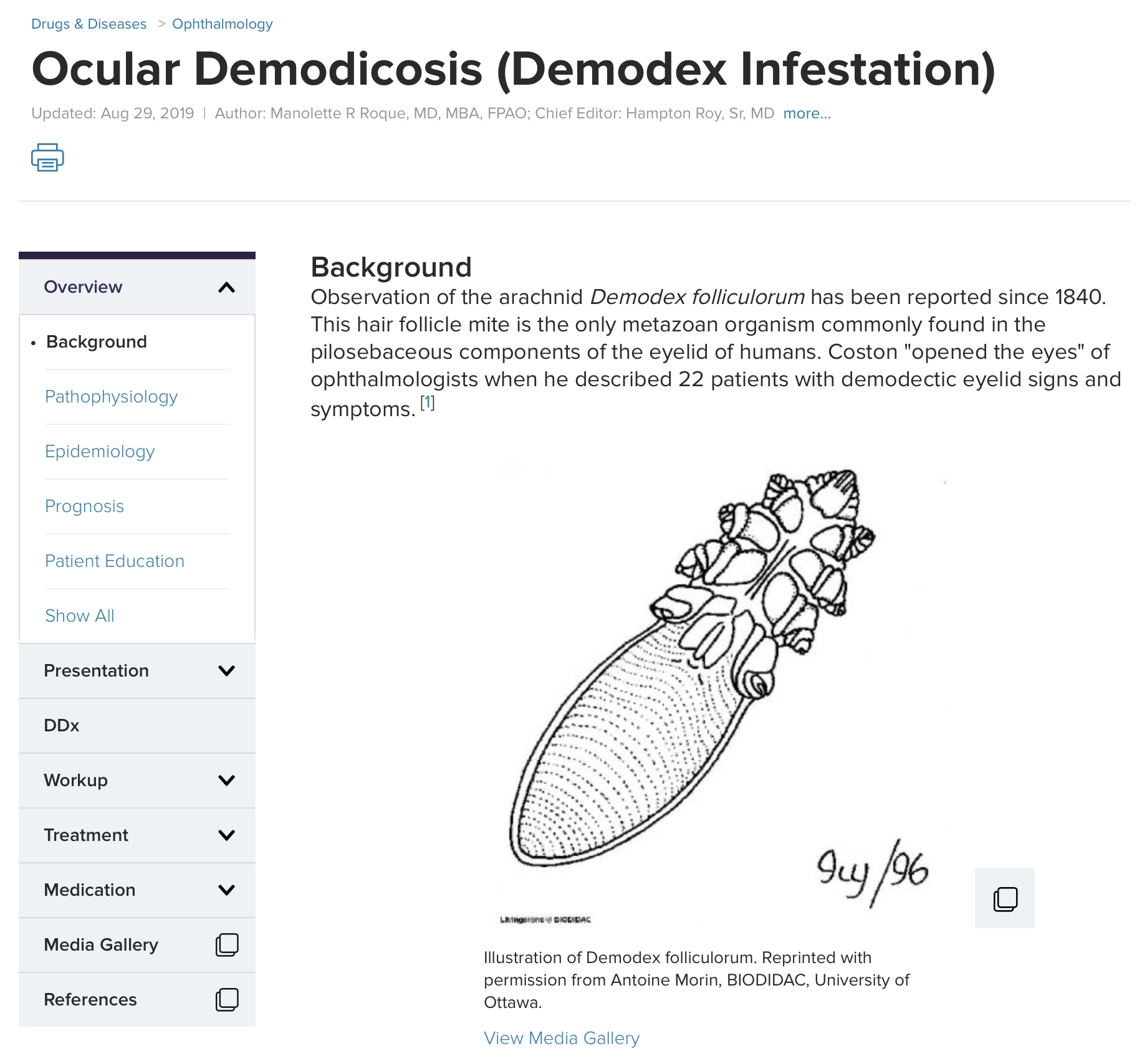 Ocular Demodicosis - Demodex Infestation