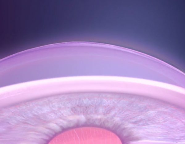 Corneal CrossLinking ROQUE Eye Clinic