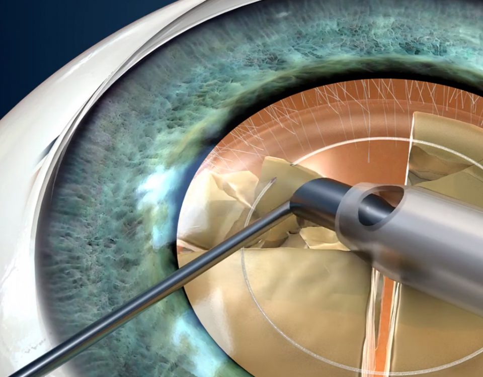 phacoemulsification of cataract