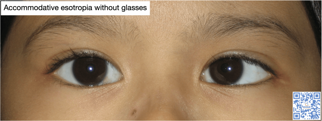 Accommodative Esotropia - ROQUE Eye Clinic | Eye.com.ph
