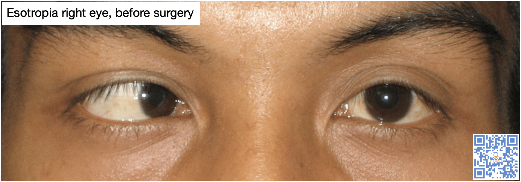 Esotropia right eye, before surgery