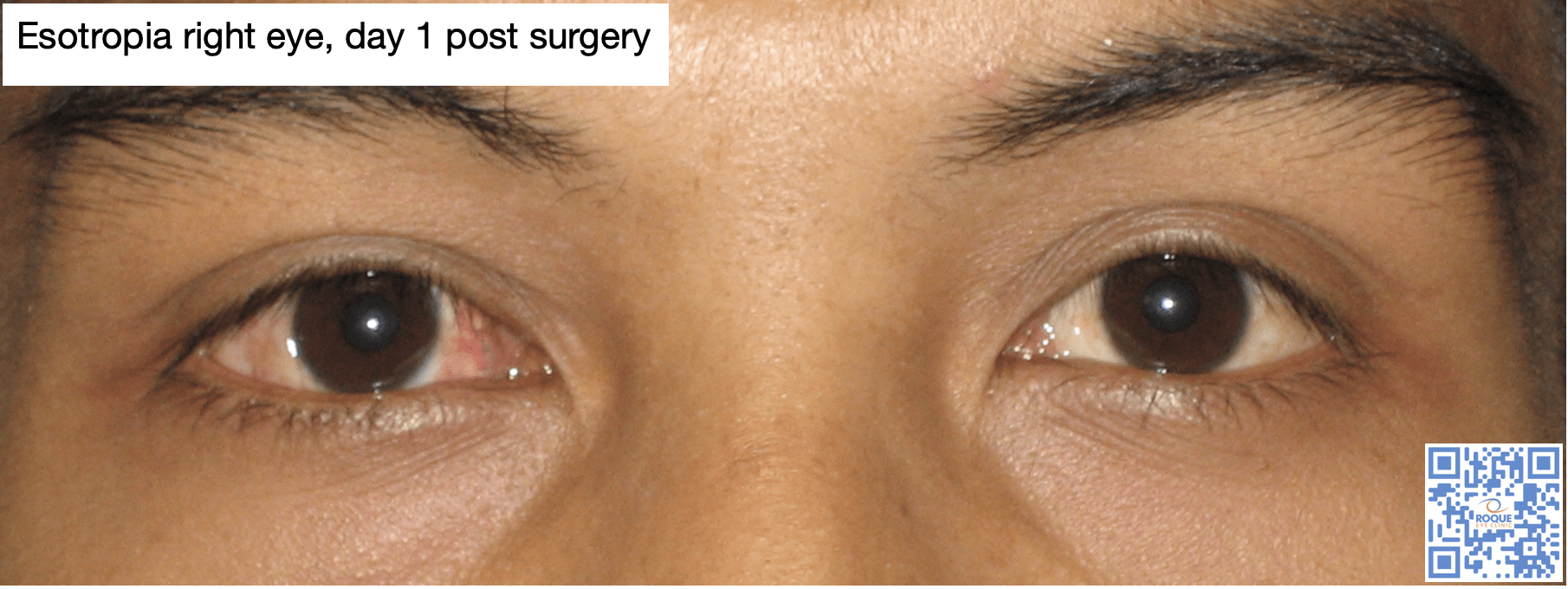STRABISMUS SURGERY - ROQUE Eye Clinic 