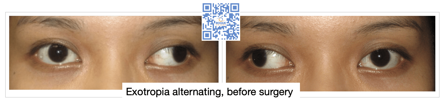 STRABISMUS SURGERY - ROQUE Eye Clinic 