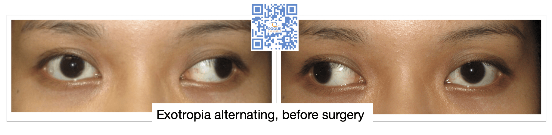 STRABISMUS SURGERY ROQUE Eye Clinic Eye ph