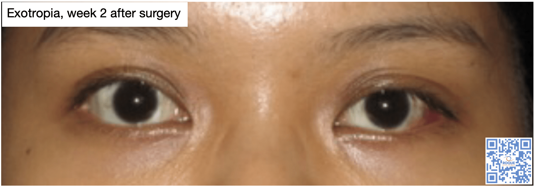 STRABISMUS SURGERY ROQUE Eye Clinic Eye ph