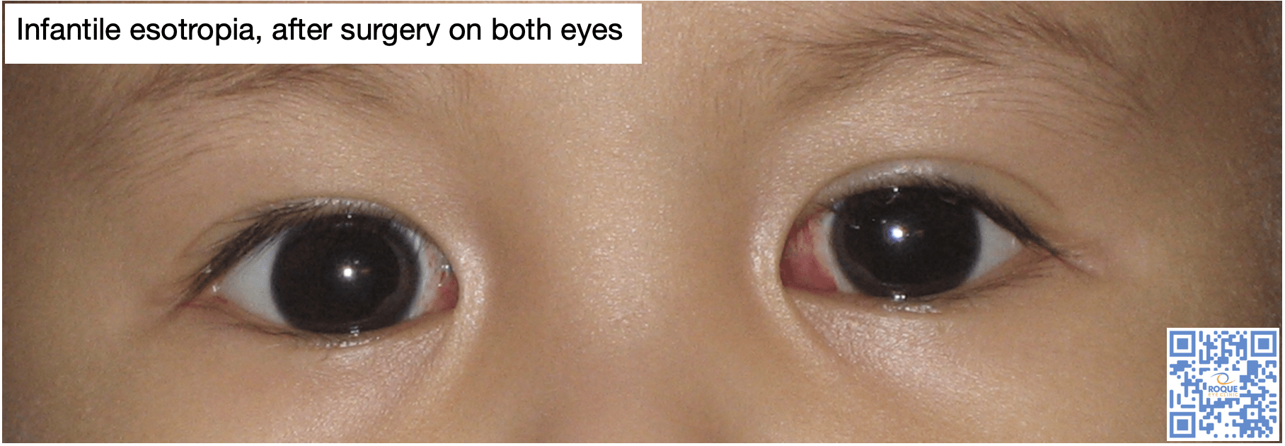 Infantile esotropia, after surgery on both eyes