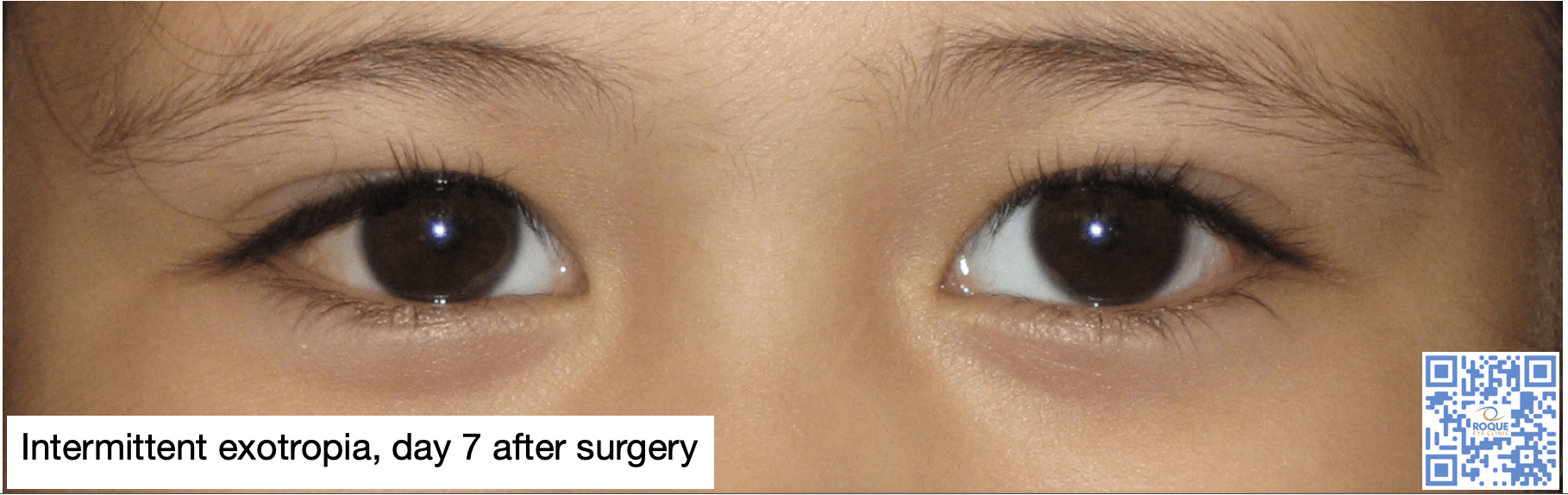 Intermittent exotropia, day 7 after surgery