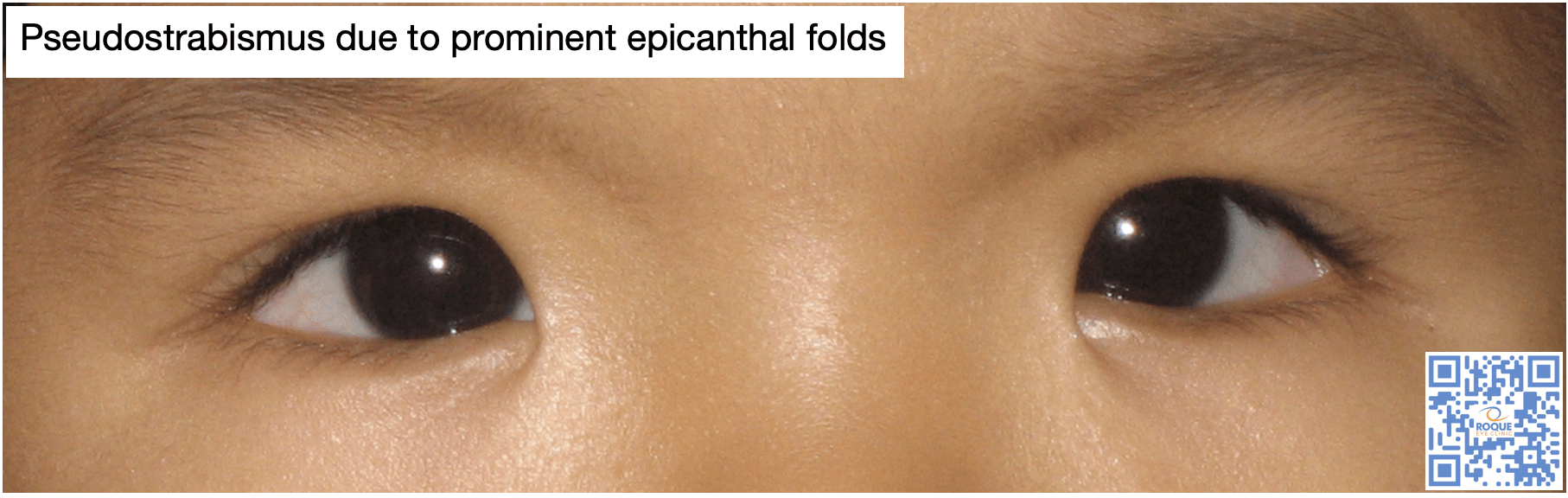 Pseudostrabismus due to prominent epicanthal folds