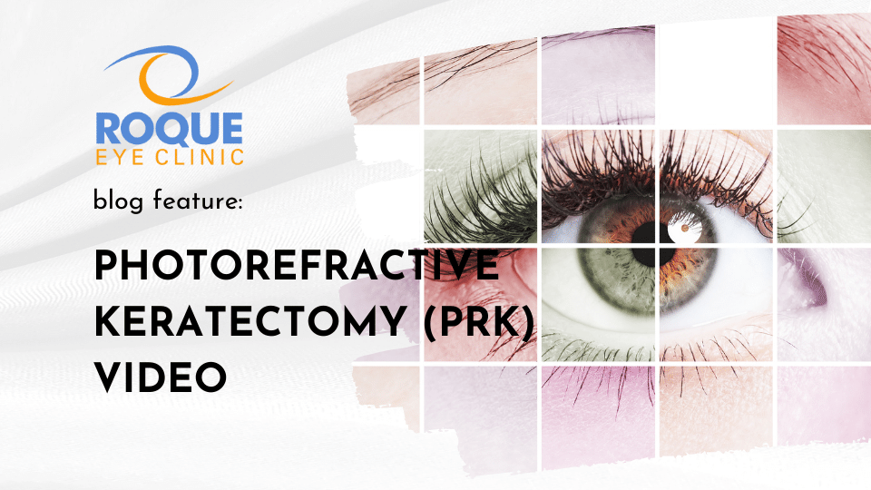 Photorefractive Keratectomy (PRK) Video ROQUE Eye Clinic