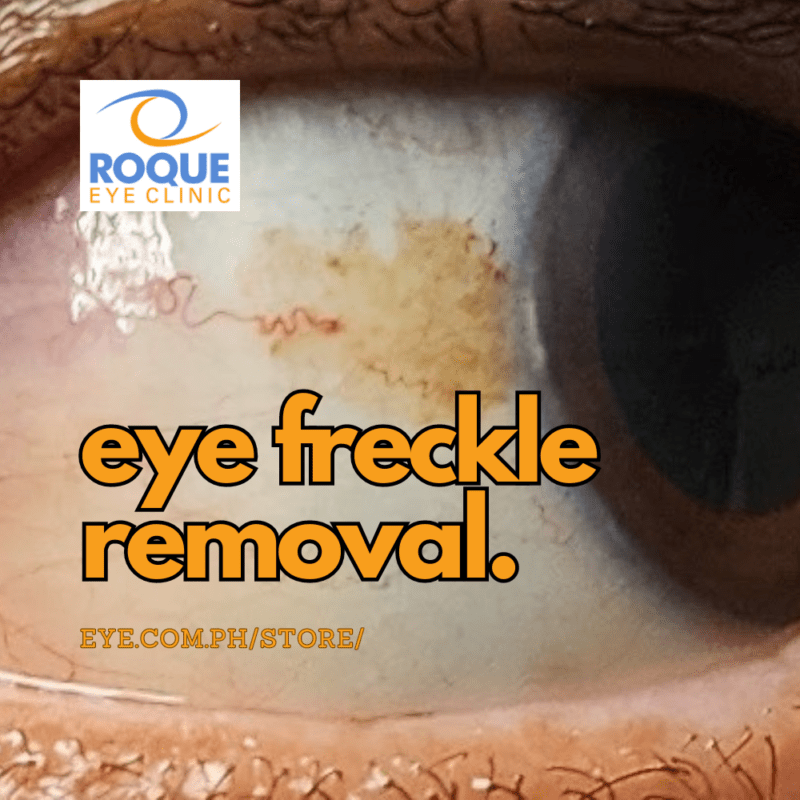 eye freckle removal