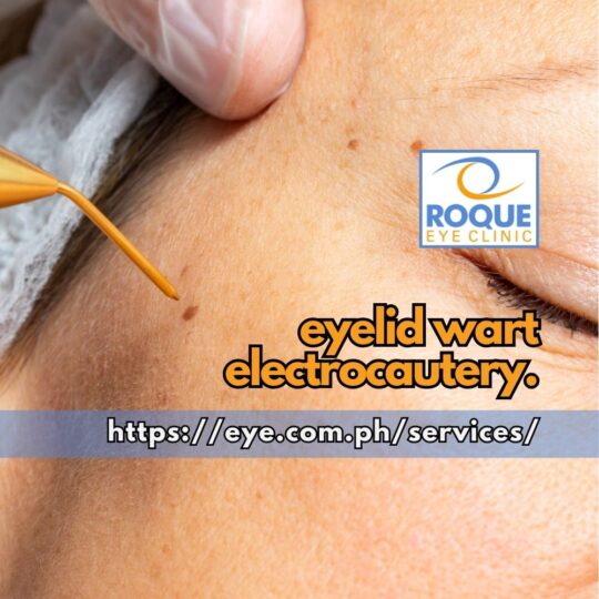 Eyelid Wart Electrocautery ROQUE Eye Clinic